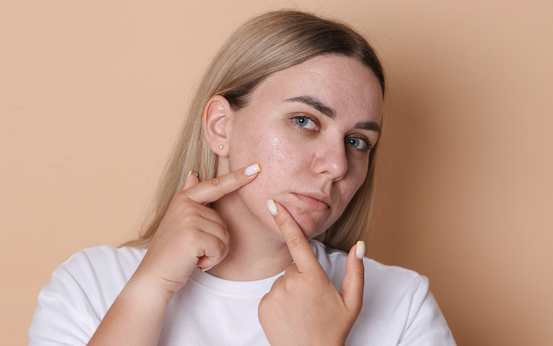 How to Get Rid of Acne Scars Permanently: Top Treatments in UAE