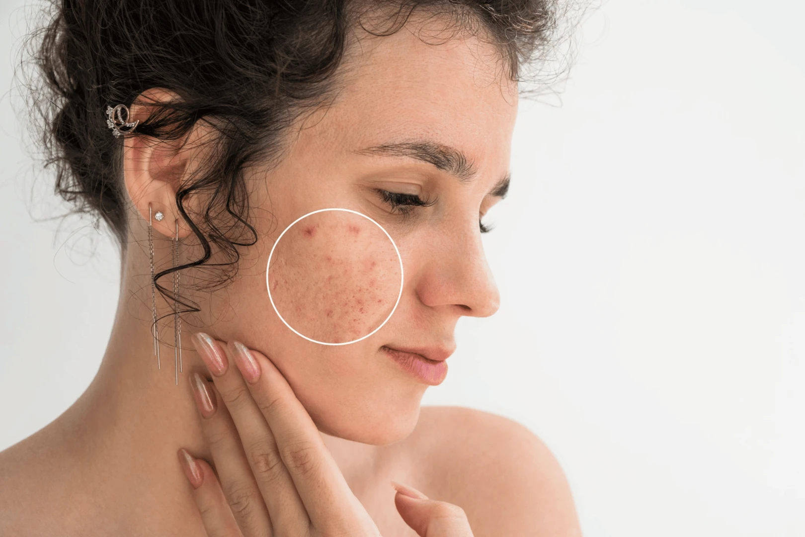 acne treatment at norel medical center in dubai
